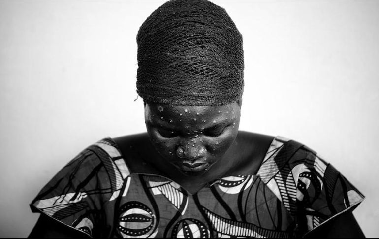 La mayoría de las personas se recuperan en varias semanas, la mortalidad sigue siendo baja. EL INFORMADOR/ Archivo