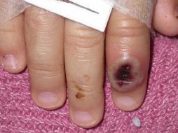 La inmunidad frente a esta enfermedad es muy escasa entre la población joven en vista de que el grupo por debajo de los 40 o 50 años no ha recibido la vacuna contra la viruela. EFE / Cortesía CDC