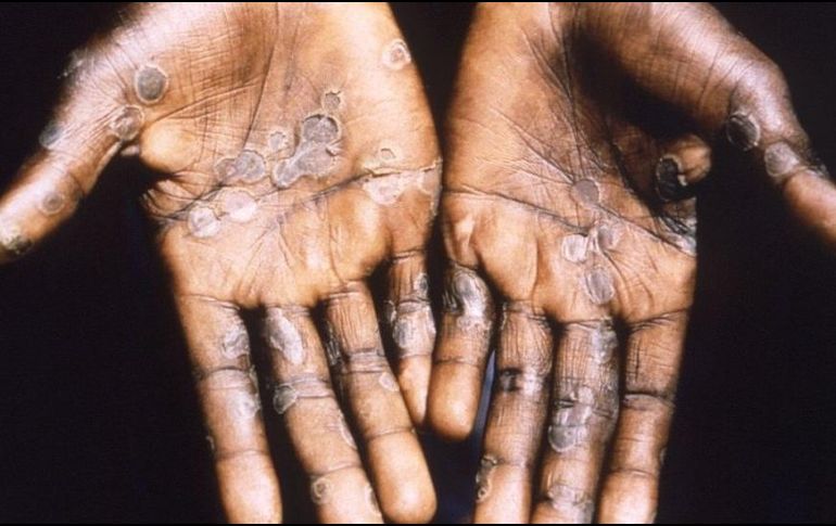 Pústulas características de la viruela del mono en paciente en la República Democrática del Congo. GETTY IMAGES