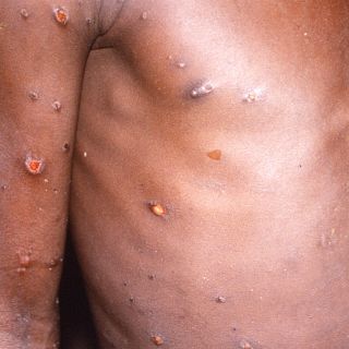 Viruela del mono: cómo se transmite, cuáles son los síntomas y qué hacer para evitar contagiarse