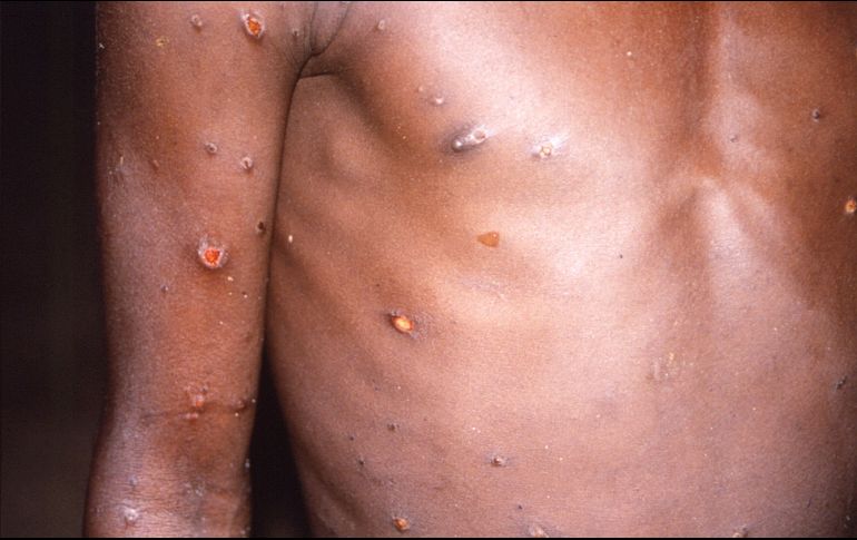 Emiten alerta para detectar casos de viruela del mono en México. EFE/B. Mahy-Center for Disease Control and Prevention