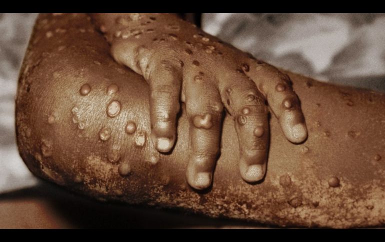 Viruela del mono: 10 razones para ser optimistas