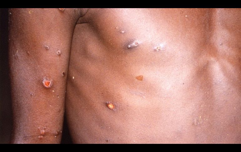 Viruela del mono: 10 razones para ser optimistas