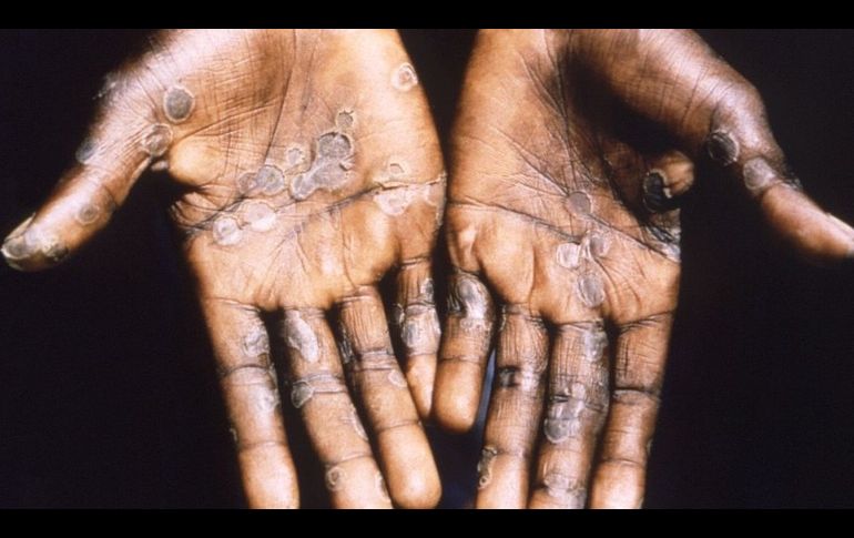 Viruela del mono: �puede convertirse en pandemia? (y otras 3 incognitas sobre esta enfermedad)