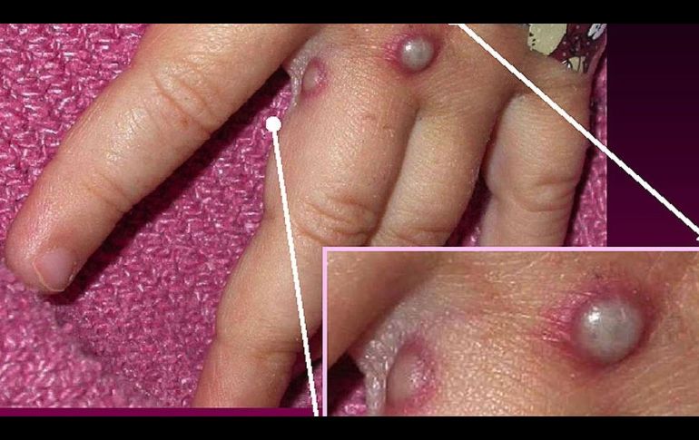 Viruela del mono: �puede convertirse en pandemia? (y otras 3 incognitas sobre esta enfermedad)
