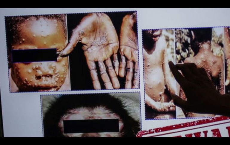 Viruela del mono | Es el mayor brote jamas visto en Europa: que es esta enfermedad detectada ya en mas de una decena de paises y que riesgos entra�a para la salud