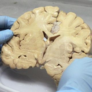 Descubren tratamiento oral experimental para tratar el Alzhéimer