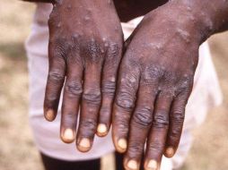 La enfermedad se localiza por lo general en el oeste y centro de África. ESPECIAL