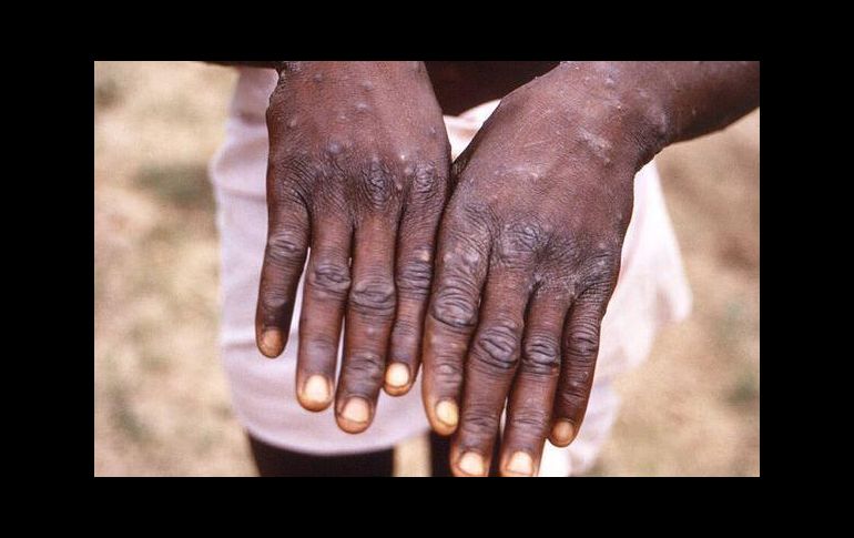 La enfermedad se localiza por lo general en el oeste y centro de África. ESPECIAL