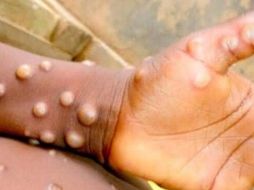 En Jalisco ya se registró el primer caso de la viruela del mono esta semana. ESPECIAL