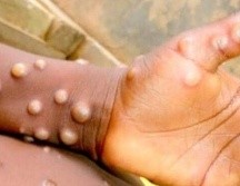 En Jalisco ya se registró el primer caso de la viruela del mono esta semana. ESPECIAL