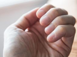 Es importante prestar atención a los cambios de color y la aparición de manchas en las uñas. GETTY IMAGES