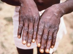 En todo el país hay 27 casos de viruela símica reportados en el sector salud. AP