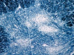 Aunque es una enfermedad incurable que puede causar parálisis muscular e incluso la muerte, la polio se puede prevenir con una vacuna, disponible desde 1955. AP/Emory University