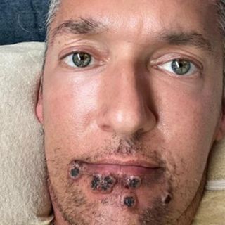 Actor infectado con viruela del mono: "No le desearía esto ni a mi peor enemigo" (FOTOS)