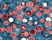 A la fecha se registran 13 casos confirmados de la viruela del mono en Jalisco. AP/NIAID