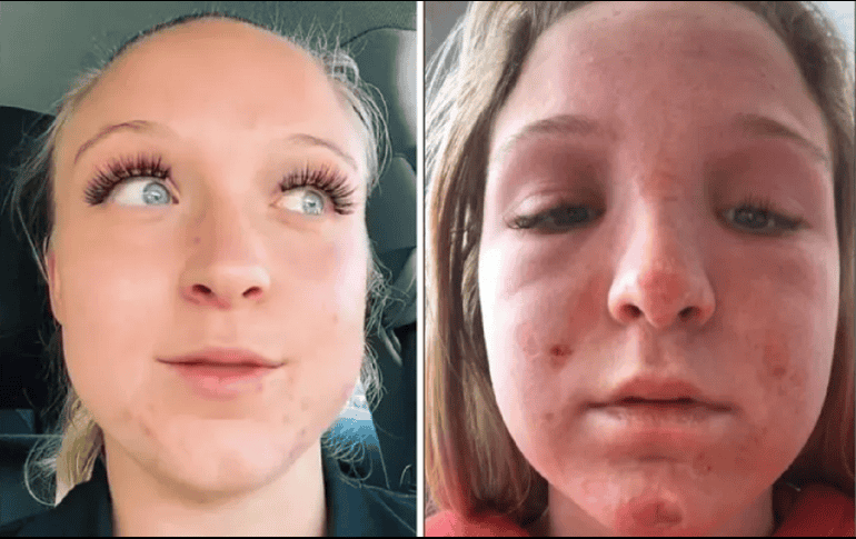 A pesar de que quedó con quemaduras en el rostro, Hoffstrom dejó claro que no iba a demandar al establecimiento. TikTok/ @emmahoffstrm