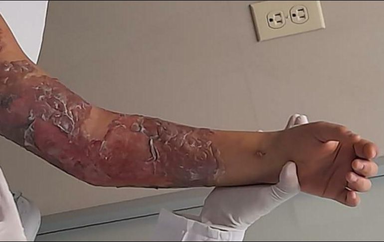 Torturan y queman a niña de 11 años en un albergue en Tonalá