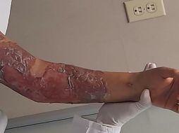 La menor de 11 años tuvo quemaduras en tórax del lado izquierdo, brazo izquierdo y abdomen. ESPECIAL