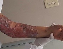 La menor de 11 años tuvo quemaduras en tórax del lado izquierdo, brazo izquierdo y abdomen. ESPECIAL