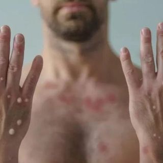 Secretaría de Salud: Protestan en la CDMX por la viruela del mono