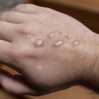 Viruela del mono: Piden que Gobierno de la CDMX habilite línea de atención ante posible contagio