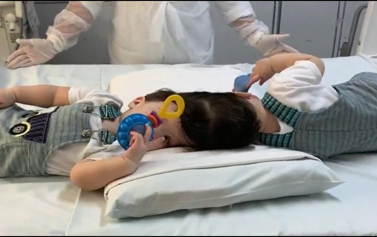 Arthur y Bernardo Lima ueron los gemelos más grandes de edad que lograron ser separados. ESPECIAL