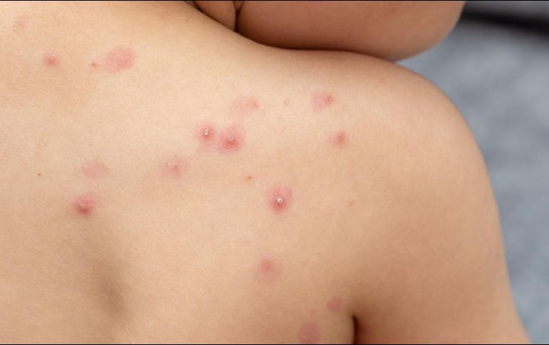 La encuesta tiene el objetivo de ser un mecanismo que facilite el registro de casos probables y confirmados en el país. EL INFORMADOR/ Archivo