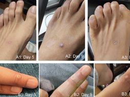 Los síntomas principales son lesiones en la piel o mucosas tipo máculas o pápulas en brazos, piernas y cara. ESPECIAL