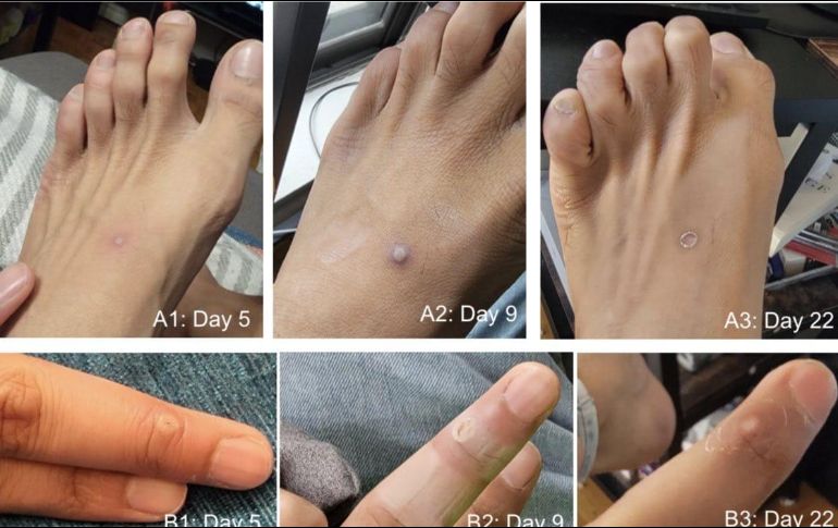 Fiebre, dolor de cabeza, malestar general, aparición de bolitas, son algunos de los síntomas de la viruela del mono. ESPECIAL