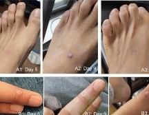 Fiebre, dolor de cabeza, malestar general, aparición de bolitas, son algunos de los síntomas de la viruela del mono. ESPECIAL