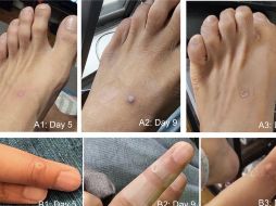 Los infectados de viruela del mono reportaron como primer síntoma lesiones en la piel y/o mucosas. ESPECIAL