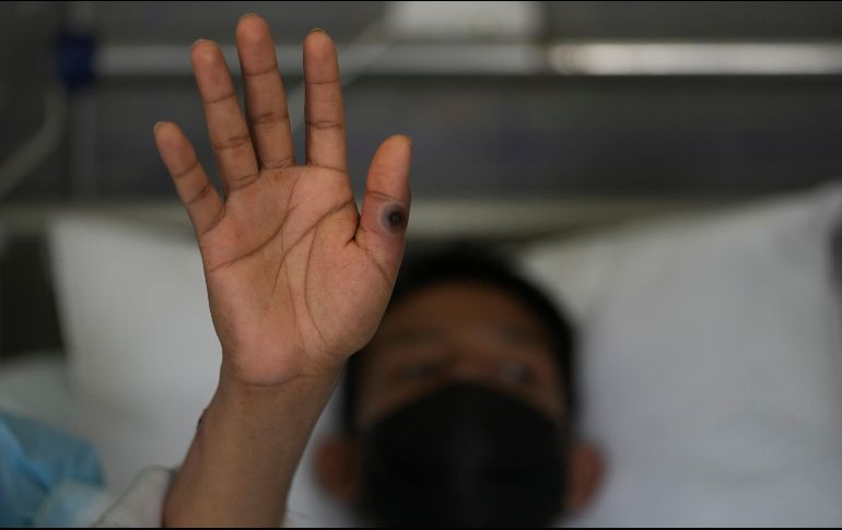 Se han notificado más de 30.000 casos de viruela del mono en América, especialmente en Estados Unidos, Brasil, Perú y Canadá. SUN/ARCHIVO