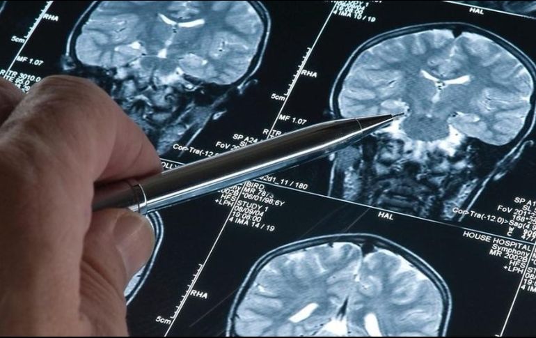 La investigación sobre la enfermedad de Alzheimer está mejorando las perspectivas de los pacientes con demencia en todo el mundo. GETTY IMAGES