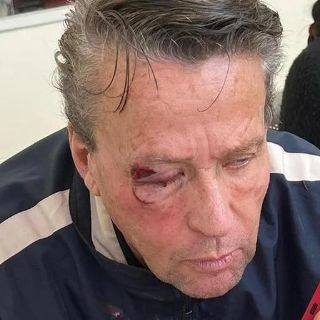 Así quedó la cara de Alfredo Adame tras su cirugía