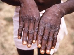 Según expertos, la disminución de la epidemia se debe en gran medida al cambio de comportamiento en las comunidades de riesgo, aunque la inmunización también desempeñó un papel importante. AP / ARCHIVO