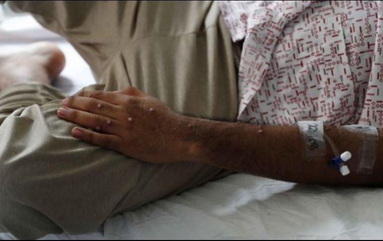 El jefe de la Unidad de Vigilante de la Sesal, Lorenzo Pavón, confirmó dos nuevos casos de viruela del mono en el país centroamericano. SUN/ ARCHIVO