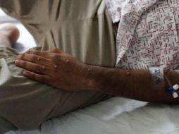 La OMS reportó a mediados de noviembre que ya existen 65 mil casos de viruela de mono en el mundo, y advirtió sobre el peligro de su rápida propagación. SUN/ ARCHIVO