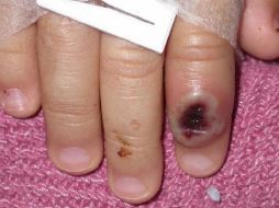 En Jalisco se tiene registro de  372 casos. ESPECIAL.