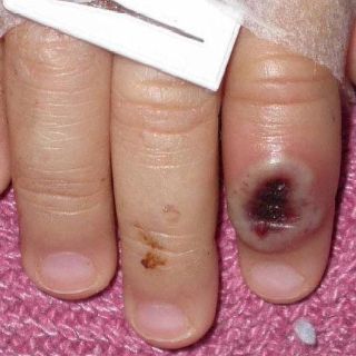 México suma tres mil 362 casos de viruela del mono