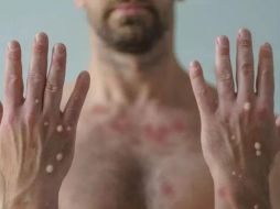 En promedio de la edad del acumulado de casos es de 33 años, 98.5 por ciento de los pacientes pertenecen al sexo masculino. ARCHIVO