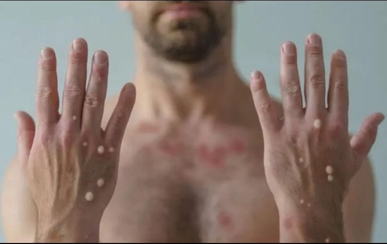 En Jalisco se han presentado 378 casos de viruela del mono. ARCHIVO