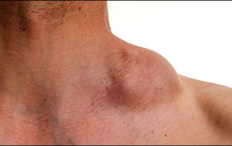 La enfermedad del linfoma de Hodgkin. ESPECIAL