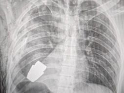 Una radiografía muestra lo cerca que se econtraba la granada del corazón del soldado ucraniano. Hanna Maliar Facebook