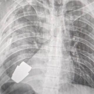 ¡Increíble! Extraen granada del pecho a un soldado ucraniano sin que explotara