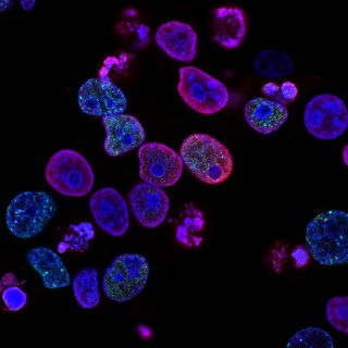 ¿Cuál es la proteína que eleva el riesgo de metástasis en el cáncer de páncreas?