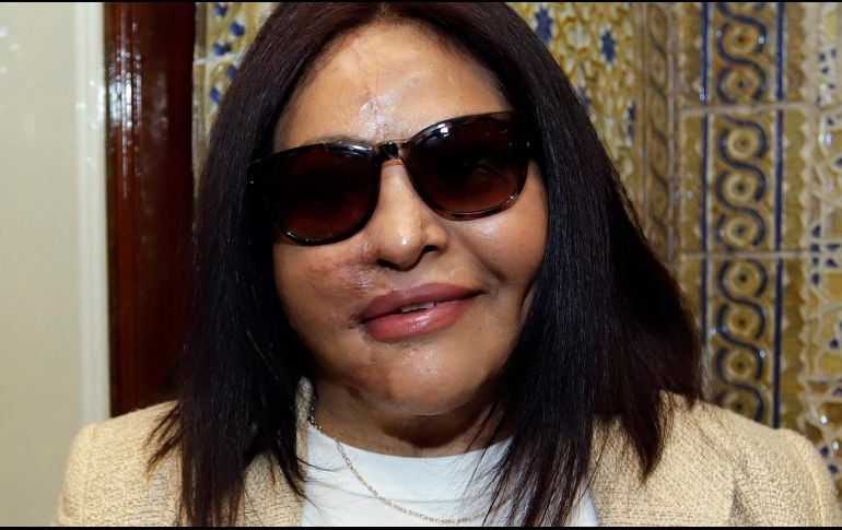 Carmen Sánchez, víctima de ataque con ácido. EFE