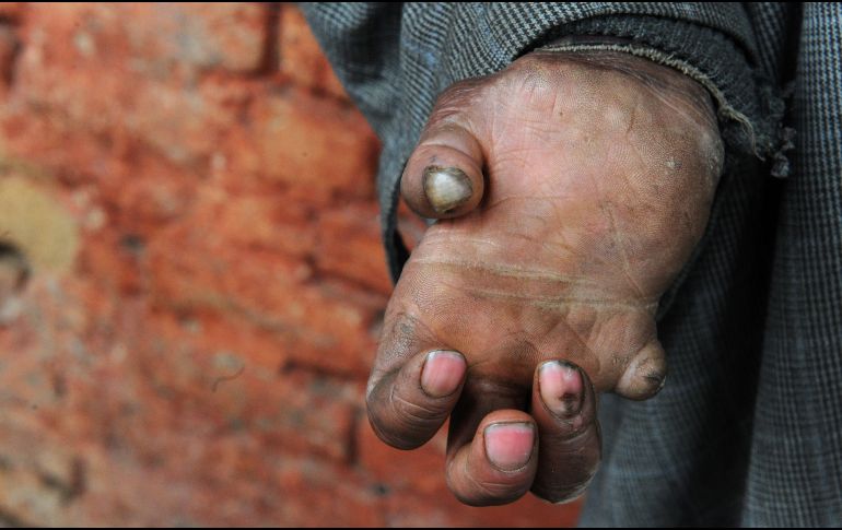 La enfermedad afecta primero a la piel, después al sistema nervioso y si no es tratada a tiempo, puede provocar parálisis, mutilación de los miembros, y ceguera. AFP / ARCHIVO