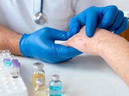 De momento no existe medicamento que elimine la afección, pero si hay algunos tratamientos de primera línea. ESPECIAL/Freepik