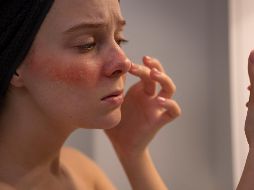 Es una de las enfermedades cutáneas más prevalentes en el mundo y la que tiene poco reconocimiento. ESPECIAL/ Freepik